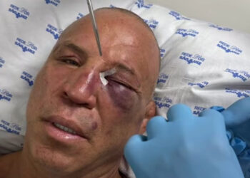 Wanderlei Silva sofre fratura no nariz e leva pontos no olho após confusão