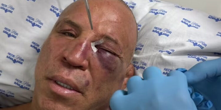 Wanderlei Silva sofre fratura no nariz e leva pontos no olho após confusão